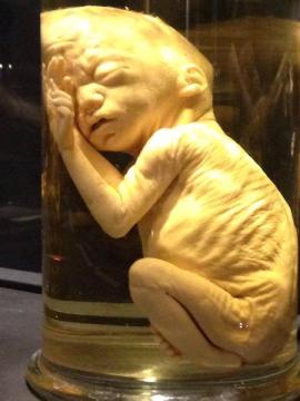 Le CHU d’Amsterdam demande les fœtus mort-nés pour développer la recherche