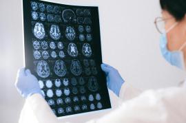 Alzheimer : prédire l’apparition de la maladie pour mieux la traiter